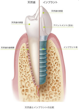 インプラントとは？