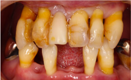 歯周病とは