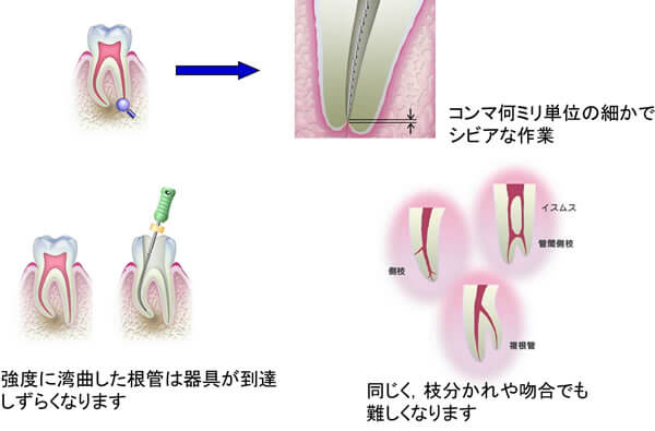 根管治療を困難にする要因