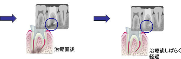 感染根管治療の流れ(全体)