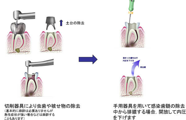 感染根管治療の流れ①