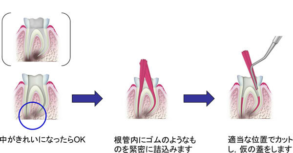 感染根管治療の流れ③