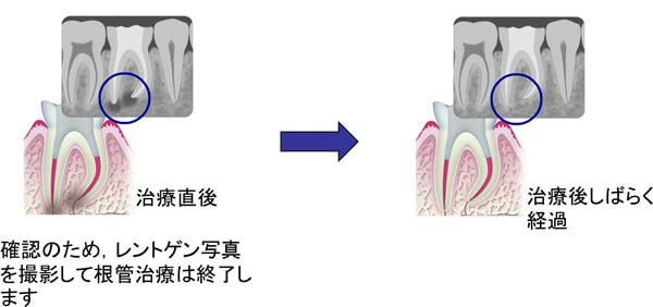 感染根管治療の流れ④