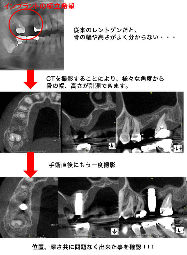 インプラント治療で・・・