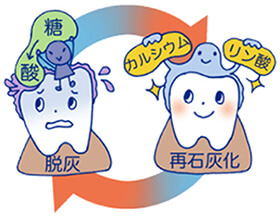 むし歯(むし歯)とは