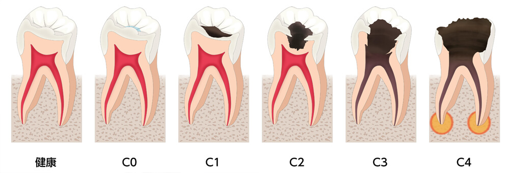 むし歯の症状