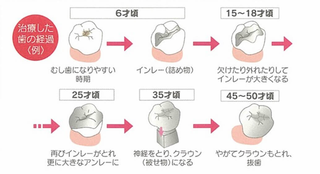 修復治療だけを繰り返した歯の寿命は…約50年