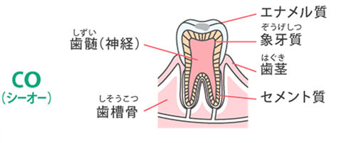 初期むし歯(経過観察)