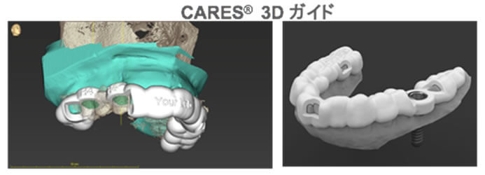 CARES 3Dガイド