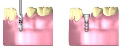 インプラント体の埋入と治癒
