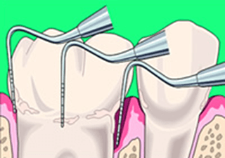 歯周病の検査ってなに？