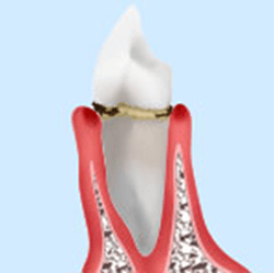 軽度の歯周病