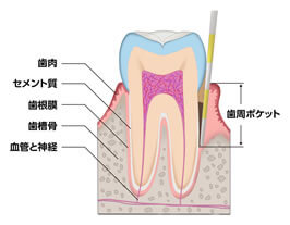 歯周病とは