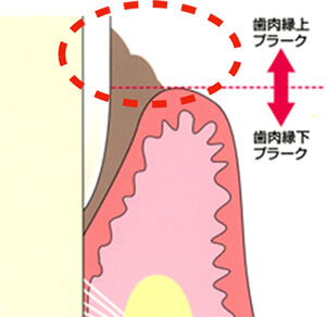 歯肉縁上プラーク（歯垢）