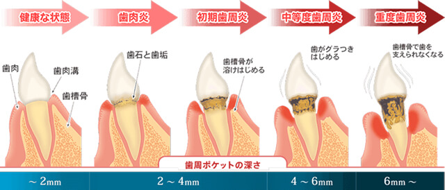 歯周病の進行度