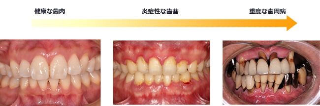 歯周病の進行度