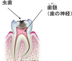 抜髄