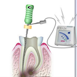 根管長測定器により歯の根の長さの測定